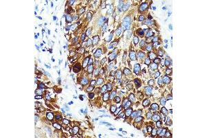 Immunohistochemistry of paraffin-embedded human lung cancer using Cathepsin B Rabbit mAb (ABIN7266148) at dilution of 1:100 (40x lens). (Cathepsin B Antikörper)