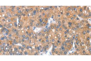 Immunohistochemistry of paraffin-embedded Human liver cancer tissue using CD238 Polyclonal Antibody at dilution 1:40 (KEL Antikörper)