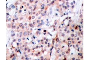 Immunohistochemistry of paraffin-embedded Human breast carcinoma tissue, using Phospho-Bcl-2(T56) Polyclonal Antibody (Bcl-2 Antikörper  (pThr56))