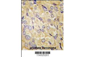 Formalin-fixed and paraffin-embedded human prostata carcinoma tissue reacted with FZD1 antibody , which was peroxidase-conjugated to the secondary antibody, followed by DAB staining. (FZD1 Antikörper  (AA 367-396))