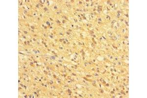 Immunohistochemistry of paraffin-embedded human glioma using ABIN7154018 at dilution of 1:100 (GATD3A (AA 43-268) Antikörper)