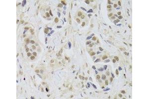 Immunohistochemistry of paraffin-embedded Human breast cancer using UBE3C Polyclonal Antibody at dilution of 1:100 (40x lens). (UBE3C Antikörper)