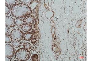 Immunohistochemistry (IHC) analysis of paraffin-embedded Human Colon Carcicnoma using GRP78/Bip Mouse Monoclonal Antibody diluted at 1:200. (GRP78 Antikörper)