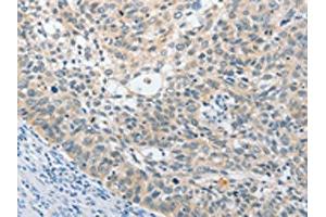 The image on the left is immunohistochemistry of paraffin-embedded Human cervical cancer tissue using ABIN7131538(UCHL5 Antibody) at dilution 1/25, on the right is treated with fusion protein. (UCHL5 Antikörper)