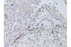 Immunohistochemistry of paraffin-embedded human breast cancer using CD34 antibody (ABIN1871618) at dilution of 1:50 (40x lens). (CD34 Antikörper)