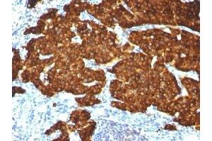 Formalin-fixed, paraffin-embedded pheochromocytoma stained with Chromogranin A antibody cocktail (Chromogranin A Antikörper)