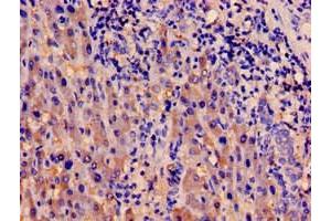 Immunohistochemistry of paraffin-embedded human liver cancer using ABIN7142002 at dilution of 1:100 (PDPK1 Antikörper  (AA 294-432))