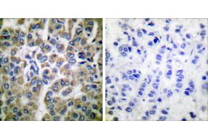 Peptide - +Immunohistochemical analysis of paraffin-embedded human breast carcinoma tissue using HSP10 antibody (#C0230). (HSPE1 Antikörper)