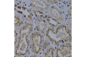 Immunohistochemistry of paraffin-embedded human kidney cancer using TNFRSF6B antibody (ABIN5970241) at dilution of 1/200 (40x lens). (TNFRSF6B Antikörper)