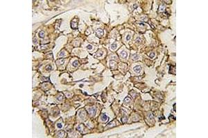 IHC analysis of FFPE human breast carcinoma tissue stained with ErbB2 antibody (ErbB2/Her2 Antikörper  (AA 21-52))