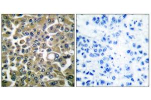 Immunohistochemical analysis of paraffin-embedded human breast carcinoma tissue using Keratin 16 antibody (ABIN5976436). (KRT16 Antikörper  (C-Term))