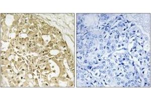 Immunohistochemistry analysis of paraffin-embedded human breast carcinoma tissue, using Catenin-beta (Ab-37) Antibody. (beta Catenin Antikörper  (AA 3-52))