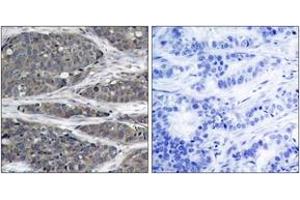 Immunohistochemistry analysis of paraffin-embedded human breast carcinoma tissue, using NF-kappaB p105/p50 (Ab-932) Antibody. (NFKB1 Antikörper  (AA 899-948))