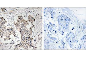 Peptide - +Immunohistochemistry analysis of paraffin-embedded human breast carcinoma tissue using BLK antibody. (BLK Antikörper  (Internal Region))