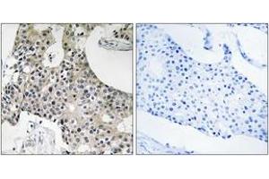 Immunohistochemistry analysis of paraffin-embedded human breast carcinoma tissue, using GPSN2 Antibody. (TECR Antikörper  (AA 259-308))