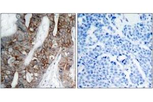 Immunohistochemistry analysis of paraffin-embedded human breast carcinoma tissue, using Integrin beta3 (Ab-773) Antibody. (Integrin beta 3 Antikörper  (AA 731-780))