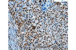 Immunohistochemistry of Human cervical cancer using CREB1 Polyclonal Antibody at dilution of 1:30 (CREB1 Antikörper)