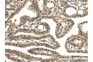 The image on the left is immunohistochemistry of paraffin-embedded Human thyroid cancer tissue using ABIN7131400(TMPRSS11E Antibody) at dilution 1/30, on the right is treated with fusion protein. (TMPRSS11E Antikörper)