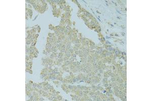 Immunohistochemistry of paraffin-embedded human colon carcinoma using MTFP1 antibody (ABIN5975088) at dilution of 1/100 (40x lens). (Mtfp1 Antikörper)