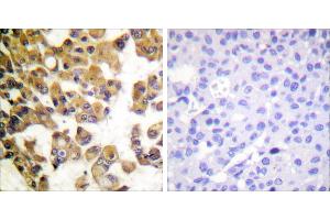 Peptide - +Immunohistochemistry analysis of paraffin-embedded human breast carcinoma tissue using BAD antibody. (BAD Antikörper  (Internal Region))
