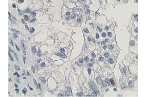 Immunohistochemical staining of paraffin-embedded Adenocarcinoma of Human ovary tissue using anti-HDHD2 mouse monoclonal antibody. (HDHD2 Antikörper)