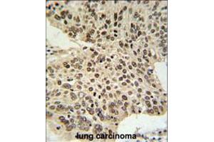 HIST1H2AL Antibody IHC analysis in formalin fixed and paraffin embedded human lung carcinoma followed by peroxidase conjugation of the secondary antibody and DAB staining. (HIST1H2AL Antikörper  (C-Term))