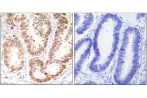 Immunohistochemistry analysis of paraffin-embedded human colon carcinoma, using p38 MAPK (Phospho-Tyr182) Antibody. (MAPK14 Antikörper  (pTyr182))