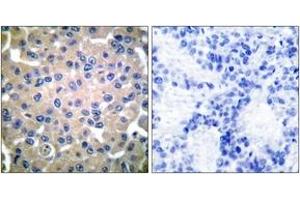 Immunohistochemistry analysis of paraffin-embedded human breast carcinoma tissue, using Transglutaminase 2 Antibody. (Transglutaminase 2 Antikörper  (AA 1-50))
