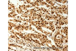 Immunohistochemistry of Human breast cancer using C12orf5 Polyclonal Antibody at dilution of 1:80 (TIGAR Antikörper)
