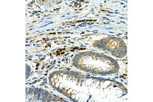 Immunohistochemistry of paraffin-embedded human colon carcinoma using MMP9 Rabbit pAb (ABIN6134758, ABIN6143921, ABIN6143924 and ABIN6215080) at dilution of 1:100 (40x lens). (MMP 9 Antikörper  (AA 400-500))
