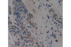 IHC-P analysis of breast cancer tissue, with DAB staining. (Anoctamin 2 Antikörper  (AA 823-1003))