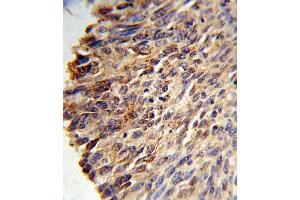 Formalin-fixed and paraffin-embedded human lung carcinoma reacted with BCL3 Antibody (Center), which was peroxidase-conjugated to the secondary antibody, followed by DAB staining. (BCL3 Antikörper  (Center))