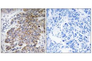 Immunohistochemistry analysis of paraffin-embedded human lung carcinoma tissue, using CHST10 antibody. (CHST10 Antikörper  (Internal Region))