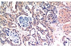 Immunohistochemistry of paraffin-embedded Human breast carcinoma tissue using Bax Monoclonal Antibody at dilution of 1:200. (BAX Antikörper)