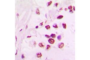 Immunohistochemical analysis of TEL staining in human lung cancer formalin fixed paraffin embedded tissue section. (ETV6 Antikörper  (C-Term))