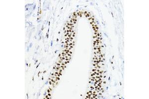 Immunohistochemistry of paraffin-embedded human mammary cancer using ZEB1 antibody (ABIN6129933, ABIN6150422, ABIN6150423 and ABIN6221237) at dilution of 1:200 (40x lens). (ZEB1 Antikörper  (AA 1-260))