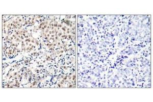 Immunohistochemical analysis of paraffin-embedded human breast carcinoma tissue using p27Kip1(Phospho-Thr187) Antibody(left) or the same antibody preincubated with blocking peptide(right). (CDKN1B Antikörper  (pThr187))