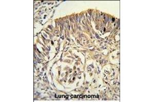Formalin-fixed and paraffin-embedded human lung carcinoma reacted with PLTP Antibody (C-term), which was peroxidase-conjugated to the secondary antibody, followed by DAB staining. (PLTP Antikörper  (C-Term))