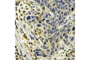 Immunohistochemical analysis of Cytochrome P450 1A1 staining in human esophageal cancer formalin fixed paraffin embedded tissue section. (CYP1A1 Antikörper)