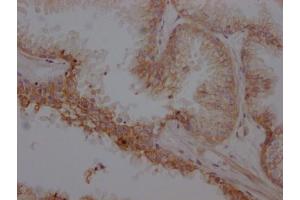 IHC image of ABIN7127366 diluted at 1:100 and staining in paraffin-embedded human prostate cancer performed on a Leica BondTM system. (Rekombinanter beta 2 Adrenergic Receptor Antikörper)