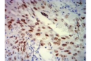 Immunohistochemical analysis of paraffin-embedded lung cancer tissues using MSH6 mouse mAb with DAB staining. (MSH6 Antikörper  (AA 374-540))