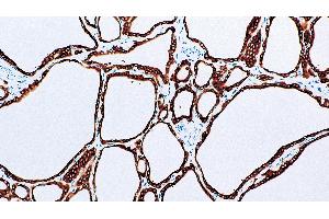 Thyroid, Graves' disease: immunohistochemical staining for Thyroid Peroxidase. (Thyroperoxidase Antikörper  (N-Term))