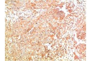 Immunohistochemical analysis of paraffin-embedded Human Breast Carcinoma Tissue using ATG7 Mouse mAb diluted at 1:200. (ATG7 Antikörper)