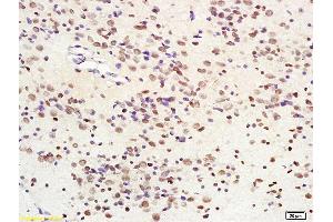 Formalin-fixed and paraffin embedded human glioma tissue labeled with Anti-SIRT1 Polyclonal Antibody, Unconjugated (ABIN679028) at 1:200 followed by conjugation to the secondary antibody and DAB staining (SIRT1 Antikörper  (AA 551-650))