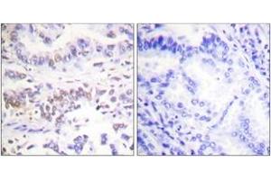 Immunohistochemistry analysis of paraffin-embedded human lung carcinoma tissue, using XRCC3 Antibody. (RCC3 (AA 41-90) Antikörper)