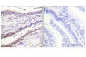 Immunohistochemical analysis of paraffin-embedded human lung carcinoma tissue using Cyclin A antibody. (Cyclin A1 Antikörper)