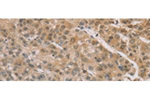 Immunohistochemistry of paraffin-embedded Human liver cancer tissue using ZIC2 Polyclonal Antibody at dilution of 1:100(x200) (ZIC2 Antikörper)