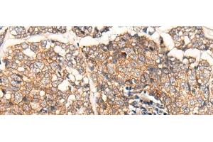 Immunohistochemistry of paraffin-embedded Human esophagus cancer tissue using CACNA2D2 Polyclonal Antibody at dilution of 1:45(x200) (CACNA2D2 Antikörper)