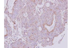 IHC-P Image Immunohistochemical analysis of paraffin-embedded human colon carcinoma, using NDUFS1, antibody at 1:250 dilution. (NDUFS1 Antikörper  (Center))
