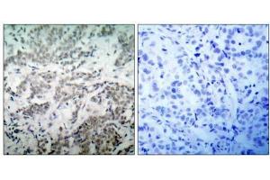 Immunohistochemical analysis of paraffin- embedded human breast carcinoma tissue using BCL-2(Ab-56) antibody (E021059). (Bcl-2 Antikörper)